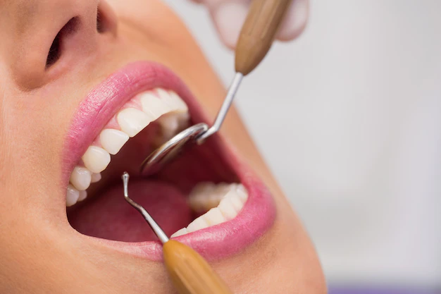 Porque manter seus dentes saudáveis com limpeza dental regular